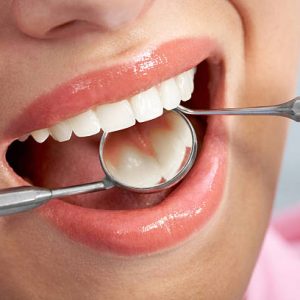Close-up of patient’s open mouth during oral checkup with mirror and hook