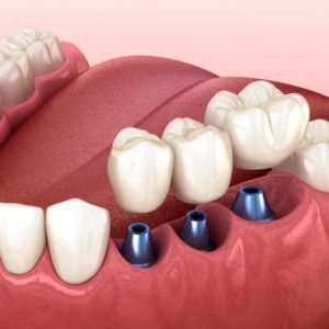 3 tooth crowns placement over 3 implants - concept. 3D illustration of human teeth and dentures